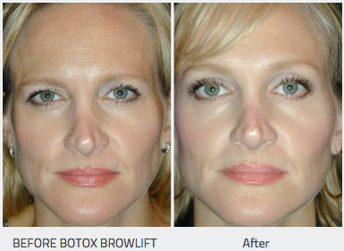 Botox 2
